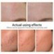 8X (Lanbena heg eltávolító szérum striák Pockmark javító Essence Face Cr H2X9