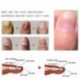 Rtopr gyömbér antibakteriális körömkezelő onchomycosis Paronychia Anti Fun H9W6