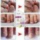 Rtopr gyömbér antibakteriális körömkezelő onchomycosis Paronychia Anti Fun H9W6
