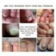 Rtopr gyömbér antibakteriális körömkezelő onchomycosis Paronychia Anti Fun H9W6