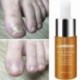 LANBENA körömkezelő krém Fényes gombás körömjavító Remonti U5F1 onchomycosis onchomycosis